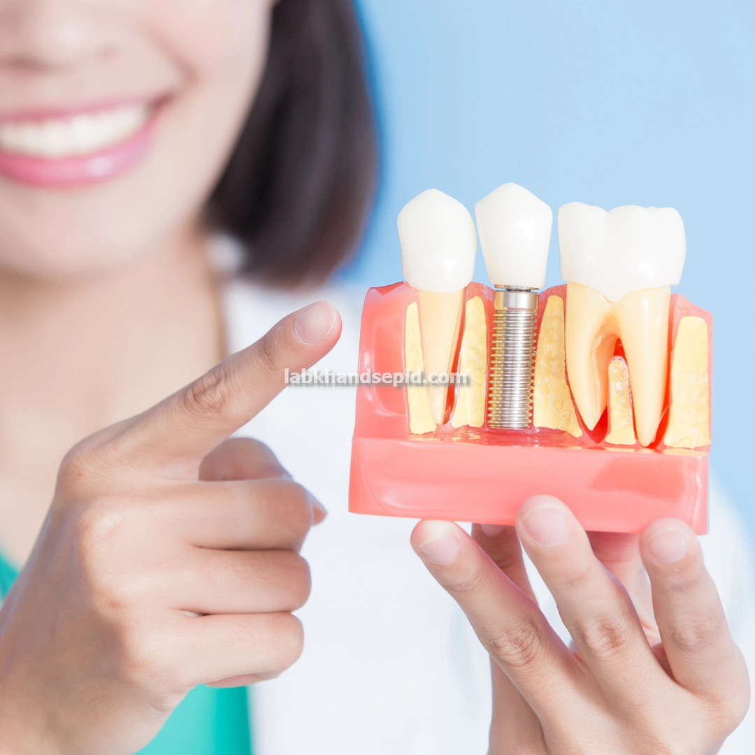 ایمپلنت اقساطی با بهترین کیفیت مواد پزشکی در شرق تهران